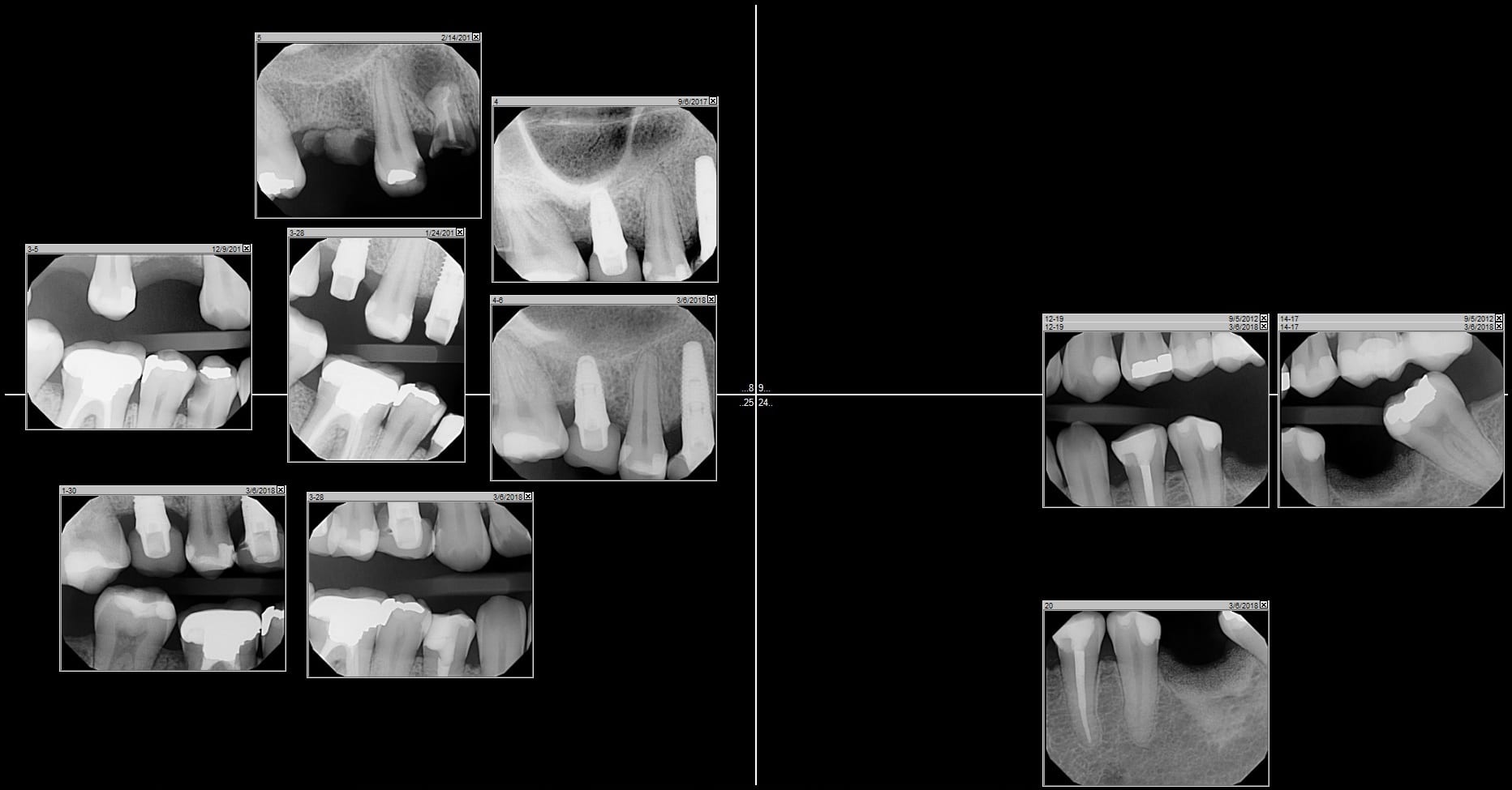 4 Composite Veneers