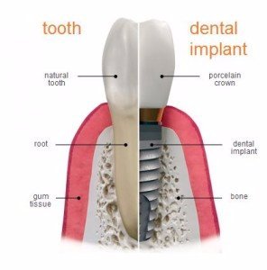 implant-restoration