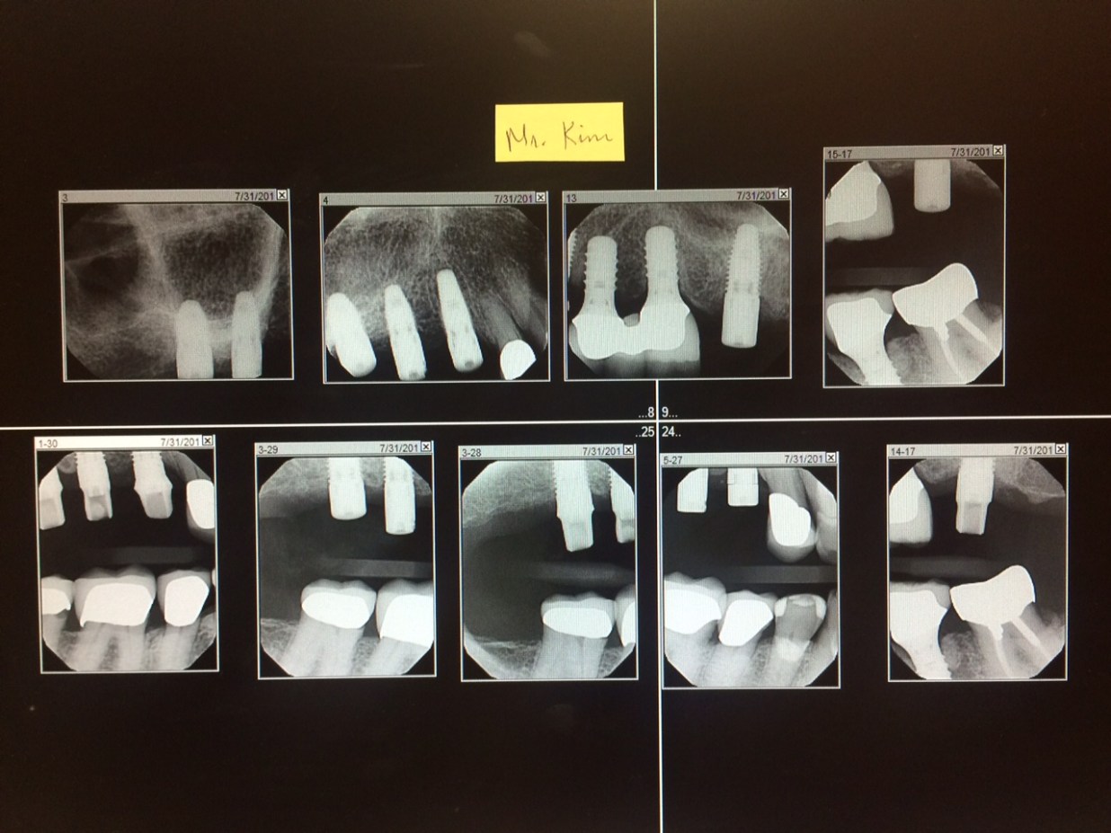 implant for me xray