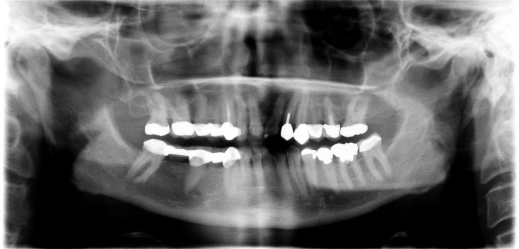 Healthy Implants For Over 10 Years