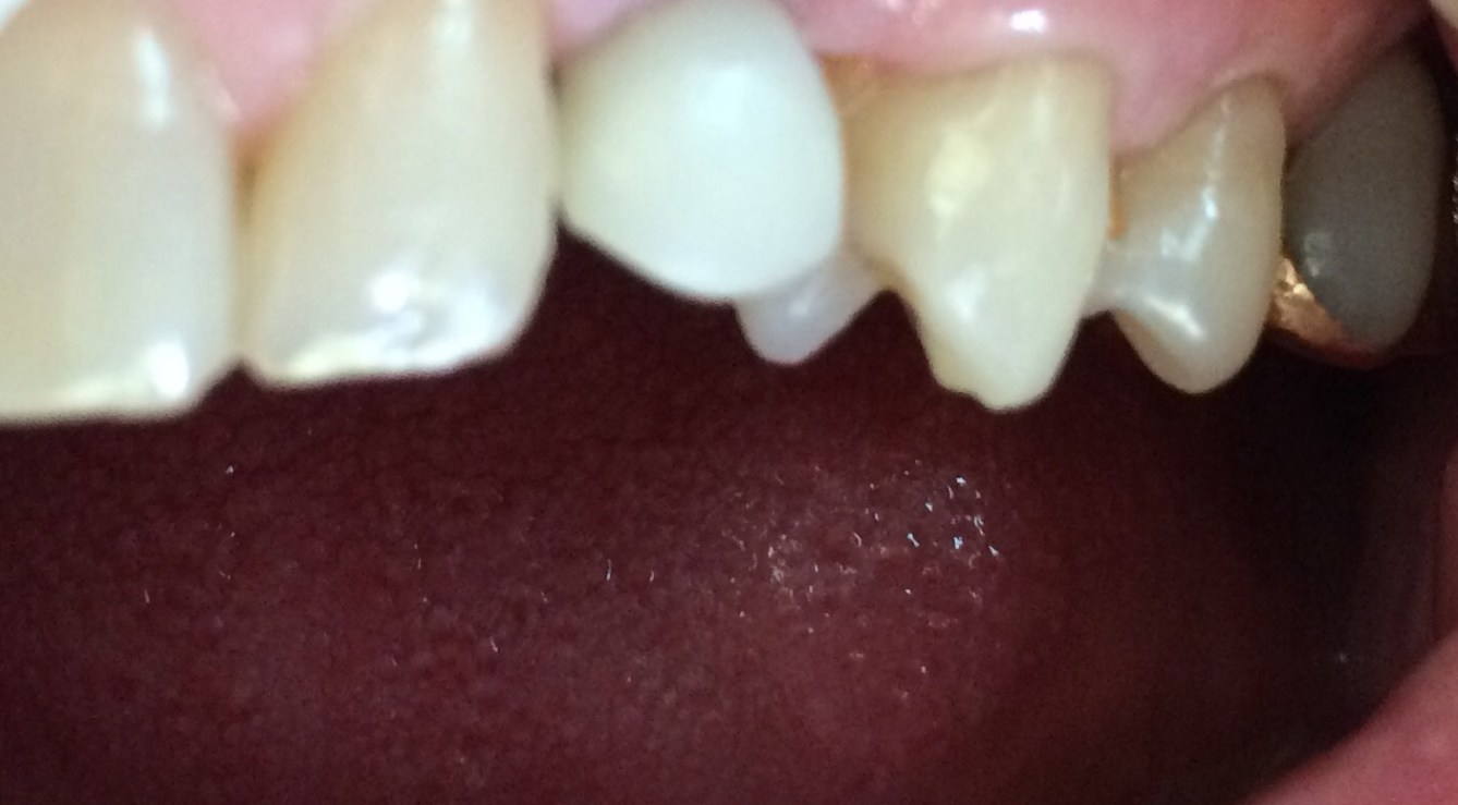 implant for me