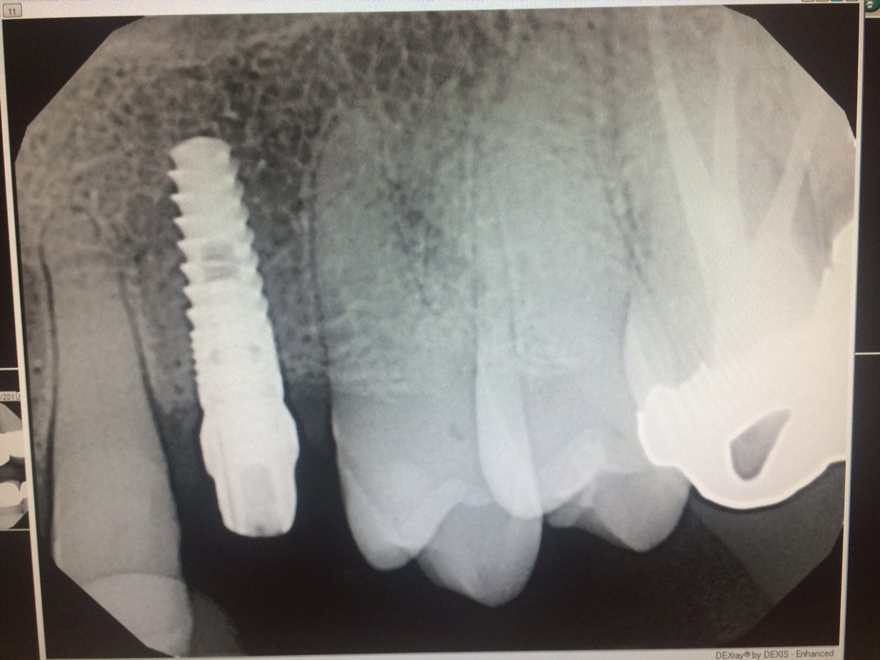 implant for me