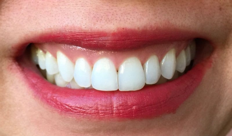 teeth-whitening