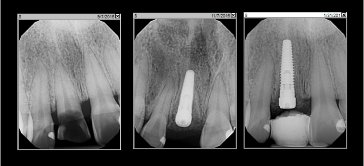 Broken Tooth in Half X Ray