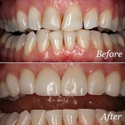 veneers