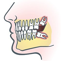 wisdom-teeth